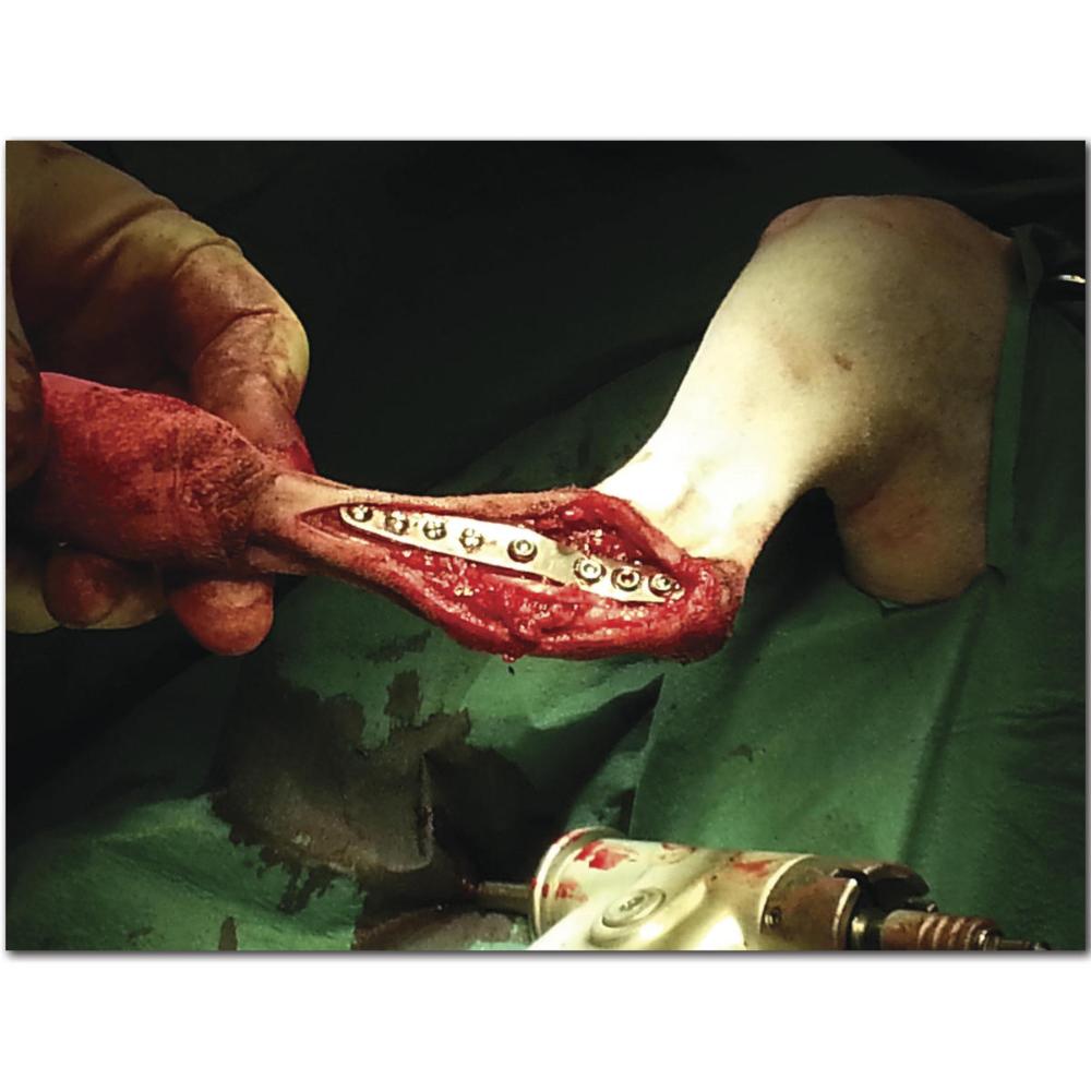2,0/2,0mm Intertarsale-Hybrid-Arthrodese-Platte (152923)