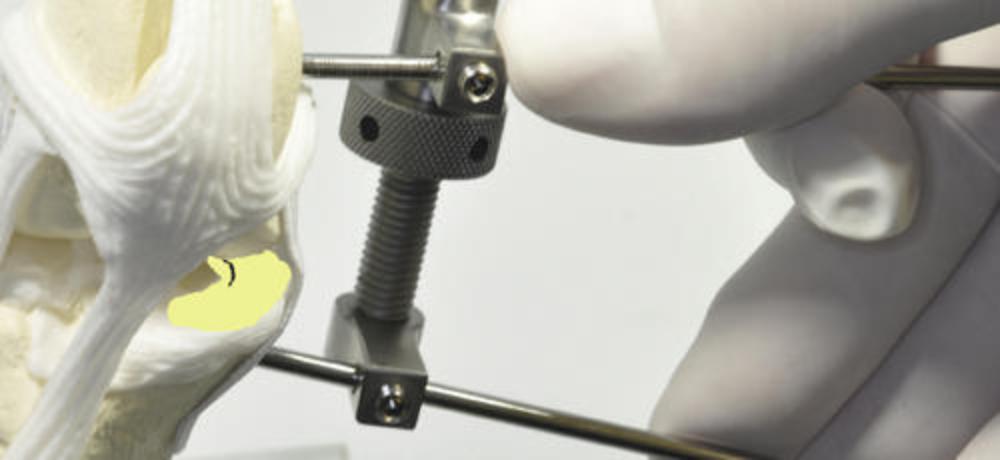 Gelenkspreizer Extraartikulär, 2,5mm Draht, 80mm lang (AR-17-01)
